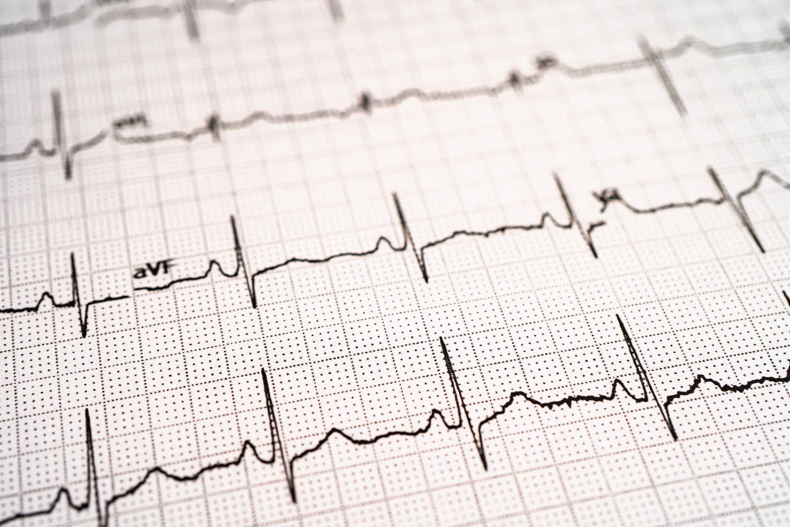 ECG waveform on a dark screen